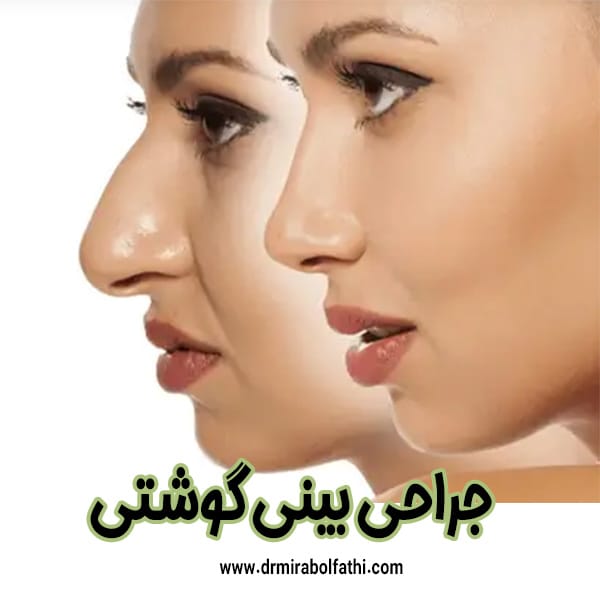 جراحی بینی گوشتی - دکتر صبا میرابوالفتحی
