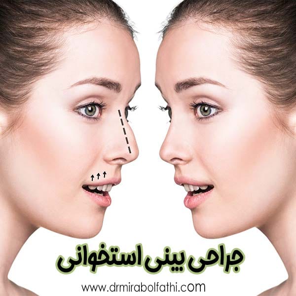جراحی بینی استخوانی - دکتر صبا میرابوالفتحی