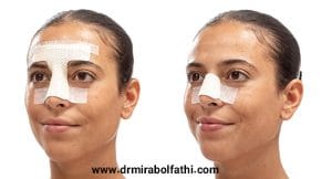 اسپلینت بینی - دکتر صبا میرابوالفتحی