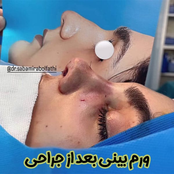 ورم بینی بعد از عمل- دکتر صبا میرابوالفتحی