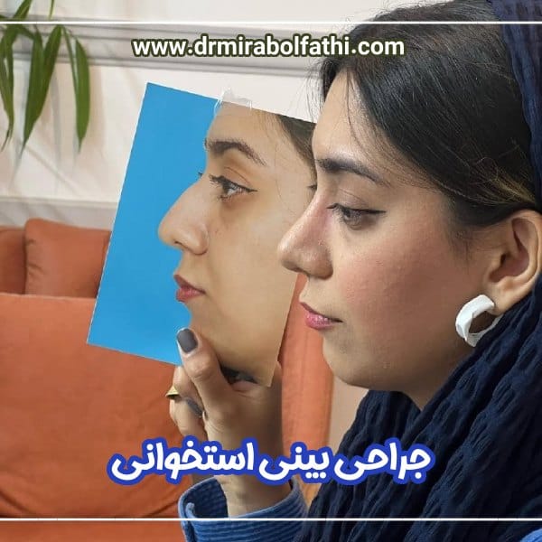 جراحی بینی استخوانی - دکتر صبا میرابوالفتحی