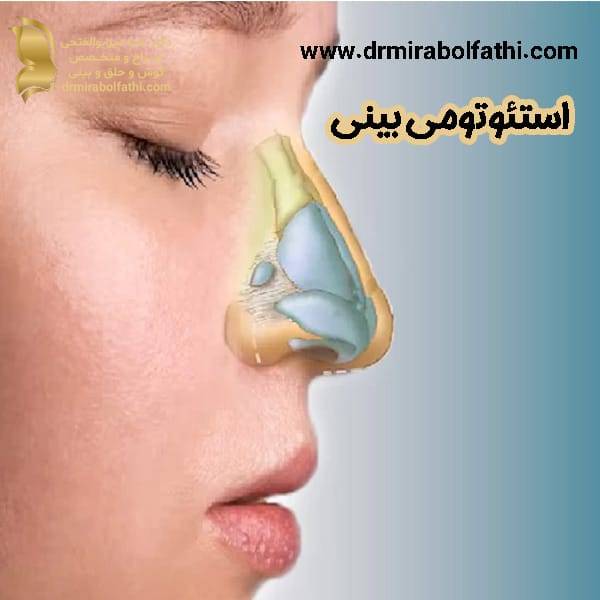 جراحی استئوتومی بینی