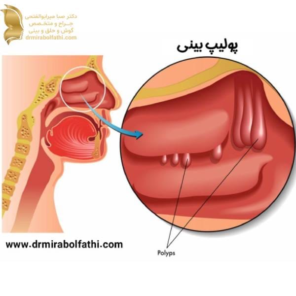 پولیپ بینی - دکتر صبا میرابوالفتحی