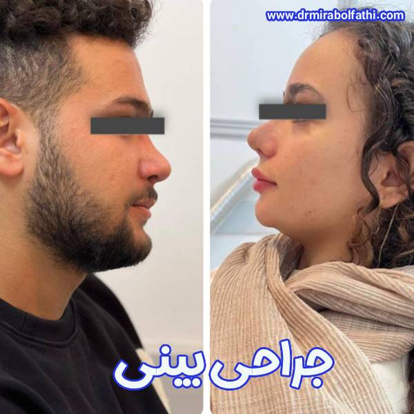 عکس جراحی بینی - بهترین جراح بینی تهران - دکتر صبا میرابوالفتحی