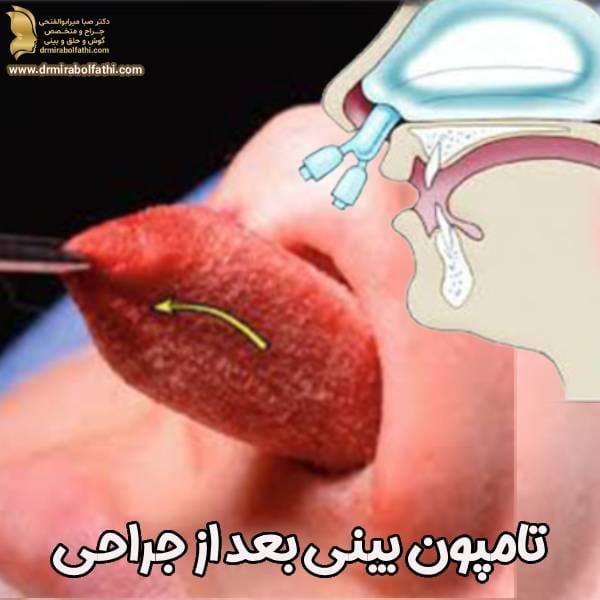 تامپون بینی بعد جراحی - دکتر صبا میرابوالفتحی